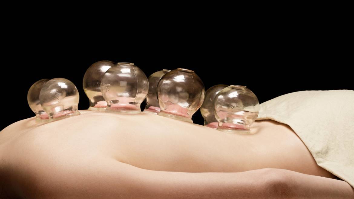 Chinese Cupping
